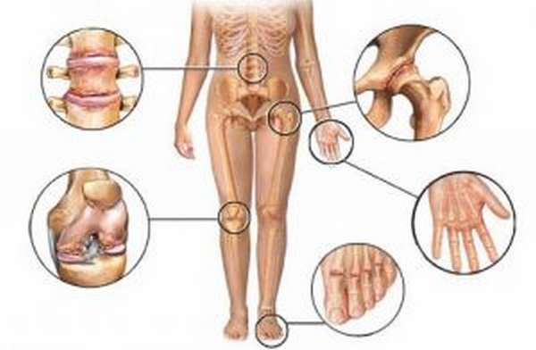 Симптомы и лечение артрита